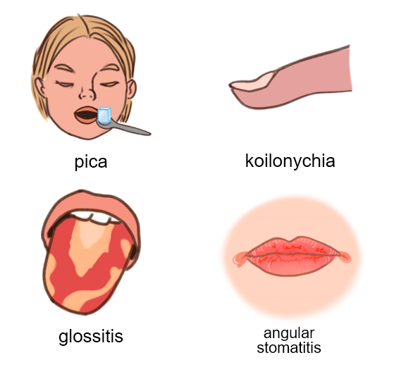 Features of iron deficiency anaemia
